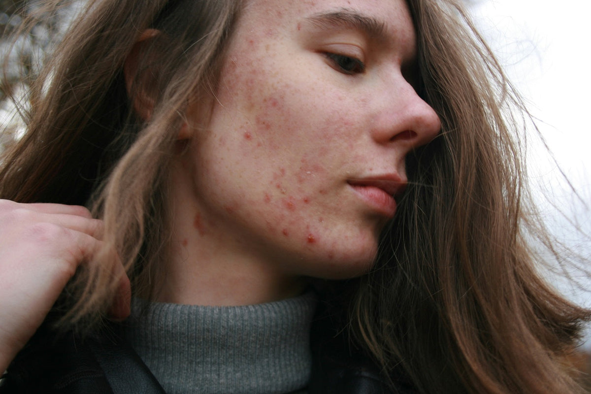 Exploring the Comedogenic Rating of Hemp Seed Oil: What You Need to Know for Acne-Prone Skin